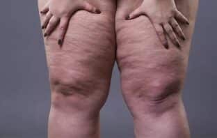 lipedema